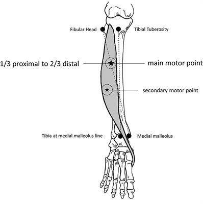 Concentric needle jitter: Reference values in stimulated Tibialis Anterior muscle